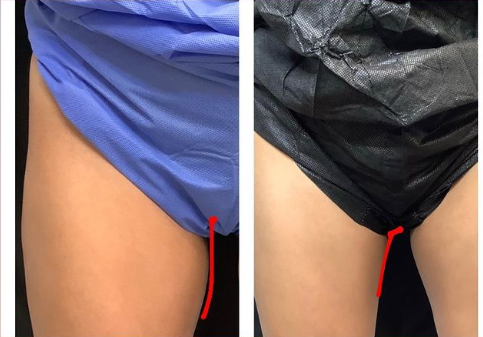 CoolSculpting® for Men