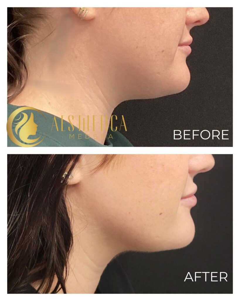 CoolSculpting® for Men