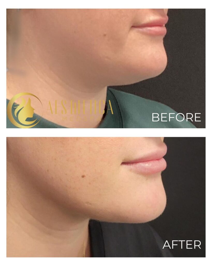 CoolSculpting® for Men