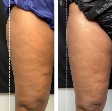 CoolSculpting® for Men