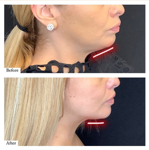 CoolSculpting® for Men