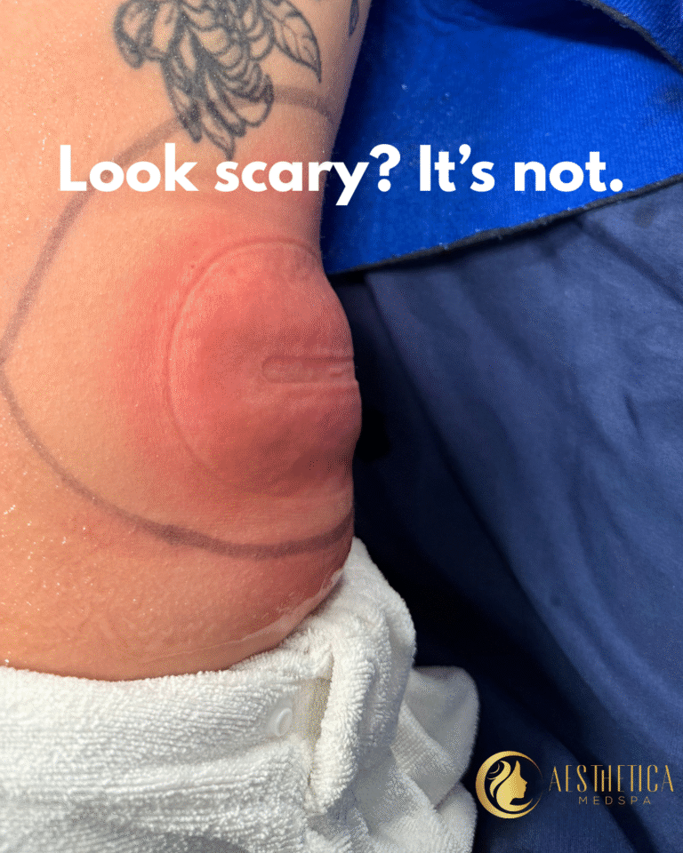 Close-up of a baby's heel with mild redness and a small horizontal scar, blue scrubs in the background, caption reads 'Look scary? It’s not.' (Aesthetica Medspa logo)